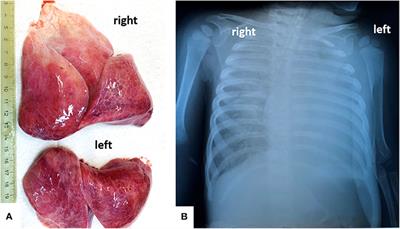 COVID-19 Like Findings in a Fatal Case of Idiopathic Desquamative Interstitial Pneumonia Associated With IgA Glomerulonephritis in a 13-Month-Old Child